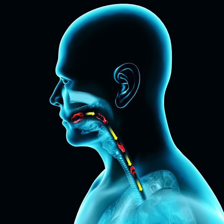 720x720 dysphagia 03