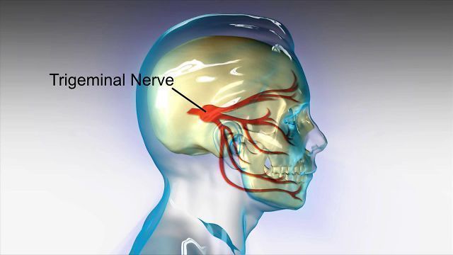 trigeminal neuralgia